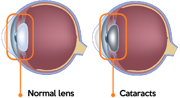 Normal lens