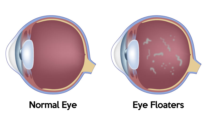 Vitreous degradation and opacity due to ageing