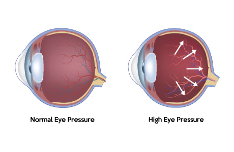 Excessive intraocular pressure can cause glaucoma