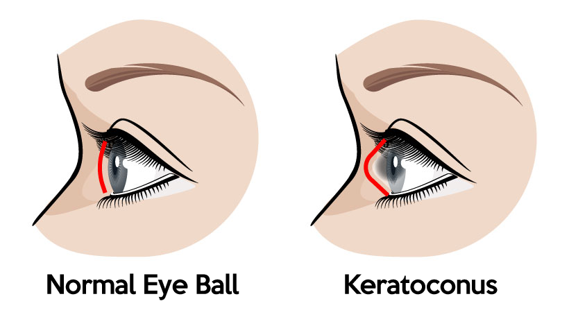 Keratoconus