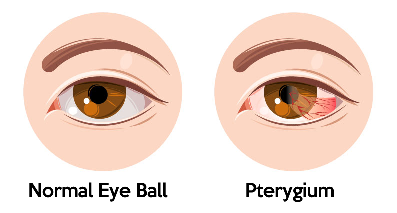 Pterygium is a benign conjunctival lesion, a triangular wing-shaped foreign body that covers the white of the eye and extends to the cornea. When the pterygium gradually grows toward the pupil, it may become inflamed and cause the white of the eye to become red and swollen.