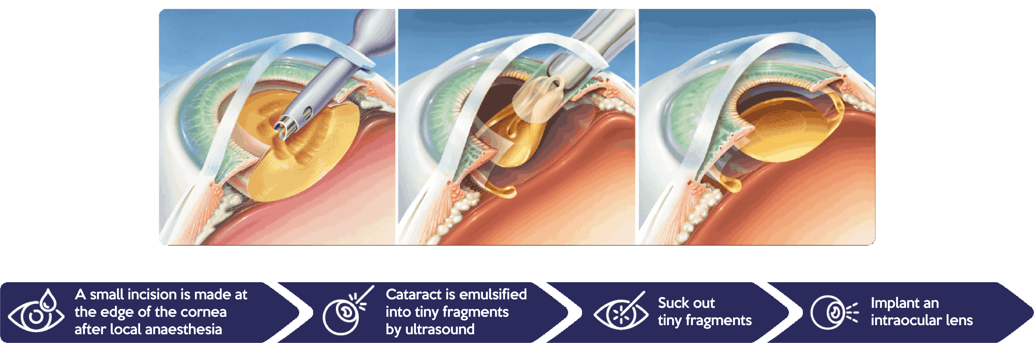 Minimally invasive phacoemulsification cataract removal surgery method