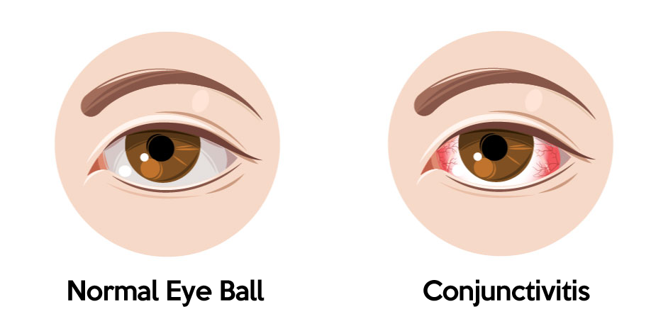 What is Conjunctivitis